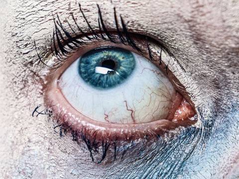 – Nahaufnahme eines weit geöffneten Auges mit blauer Iris, umgeben von rissiger, hellfarbiger Haut. Deutlich sichtbare Wimpern und rote Äderchen.